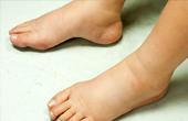 Причины появления отёков ног. Симптомы и лечение заболевания