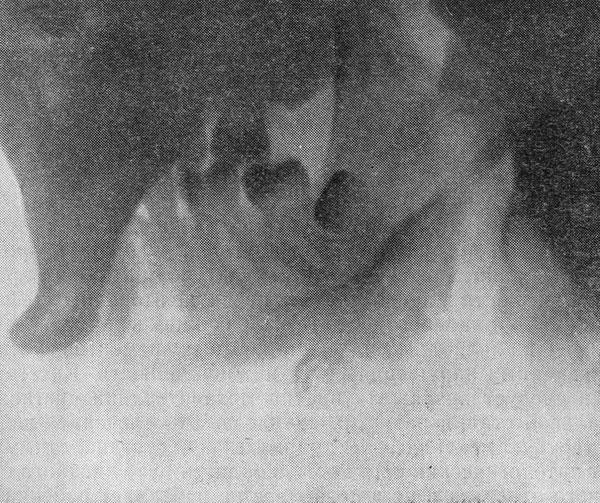 Рентгенограмма нижней челюсти с анкилозом височно-челюстного сустава