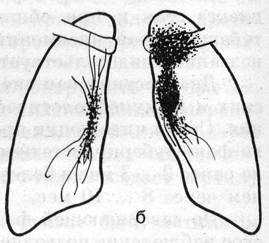 Первичный туберкулезный комплекс в левом легком (б)