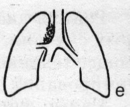 Схематическое изображение малых форм туберкулеза (е)
