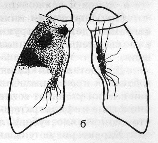 Туберкулезная долевая пневмония (б)