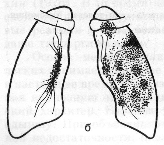 Туберкулезный инфильтрат типа перисциссурита (б)