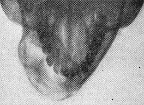 Остеобластокластома нижней челюсти