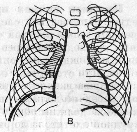 Схемы рентгенограмм органов грудной полости (в)