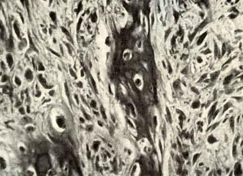 Формирование атипичных костных балок в остеогенной саркоме