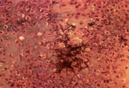 Микроскопическая картина хондробластомы