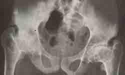 Рентгенограмма тазобедренных суставов после исправления контрактур тазобедренных и коленных суставов аппаратом Илизарова