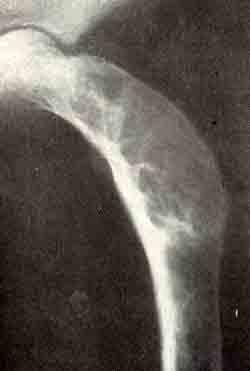 Стадии фиброзной остеодисплазии в рентгеновском изображении