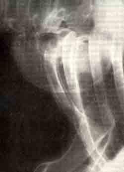 Пассивно-кистозная форма остеобластокластомы: поражение VII шейного позвонка