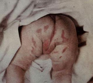 Impetigo papulosa syphiloides у грудного ребенка 43-х дней