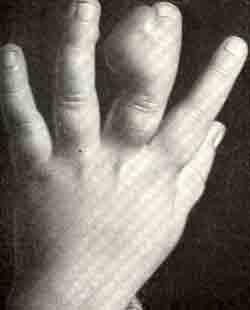 Деформация III пальца кисти при дисхондроплазии