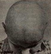 Alopecia areata totalis у девочки трех лет