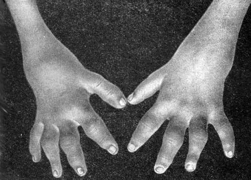 Поражение лучезапястных суставов и межфаланговых сочленений кистей рук (экссудативные явления)
