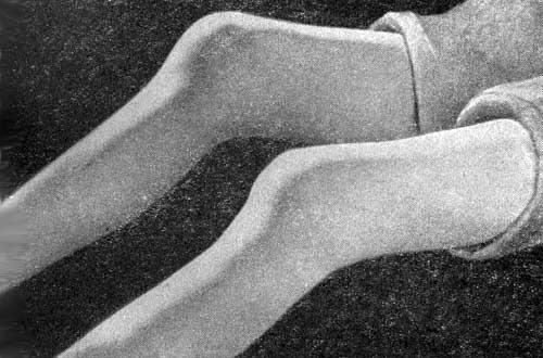 Деформация коленных суставов, преобладание пролиферативных явлений, подвывих, атрофия мышц бедер и голеней