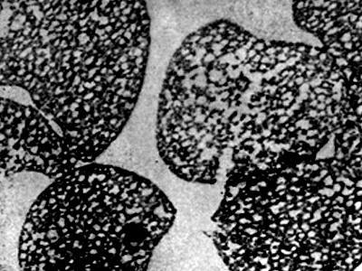 Эритроциты под электронным микроскопом больной с большой талассемией (ув. 5500)