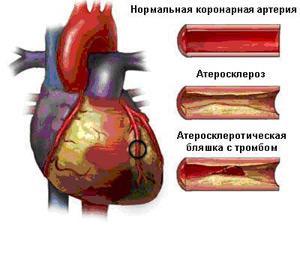 Атеросклероз коронарных артерий: причины, симптомы, лечение