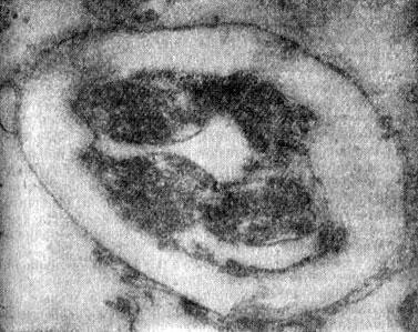 Зрелый толстостенный пневмоцист с типичным телом цисты