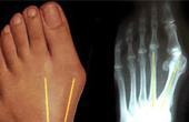 Деформация косточки большого пальца ноги