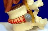 Межпозвоночная грыжа: симптомы и лечение