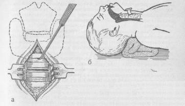 Методика трахеостомии