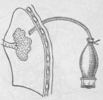 Пассивный дренаж плевральной полости по Бюлау