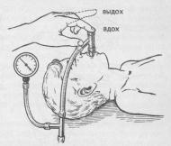 ИВЛ по методу Айра