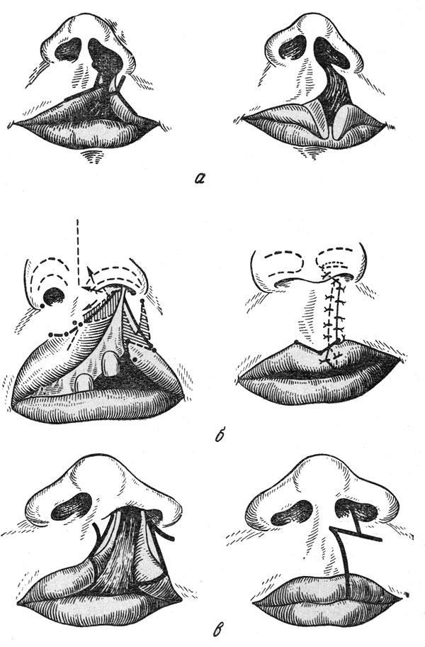 «Линейные» методы пластики верхней губы
