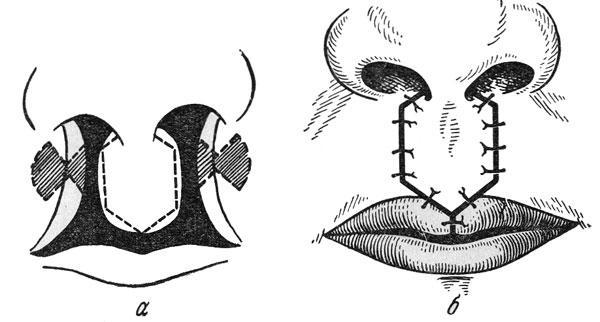 Схема операции при двусторонней расщелине верхней губы по Лимбергу