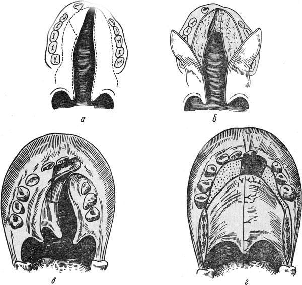Методы пластики неба при полных односторонних расщелинах верхней губы, альвеолярного отростка и неба