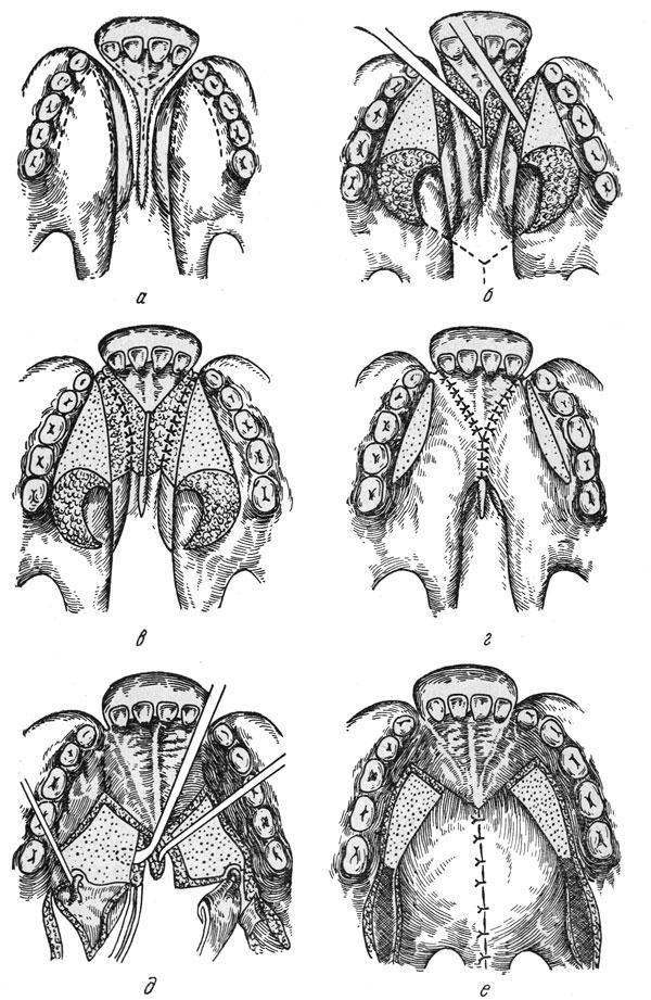 Схема пластики неба при полных двусторонних расщелинах верхней губы, альвеолярного отростка и неба