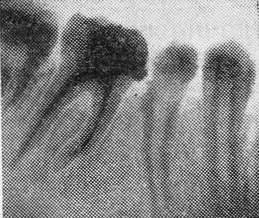 Лечение хронического периодонтита многокорневых зубов