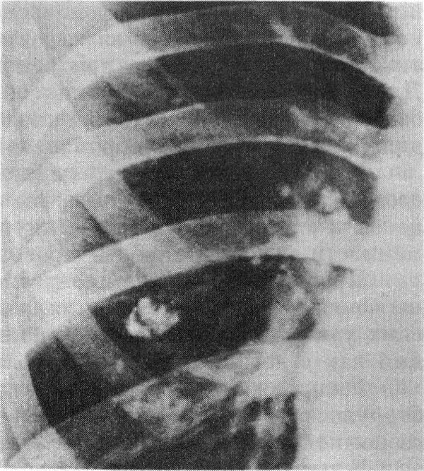 Рентгенограмма правого легкого