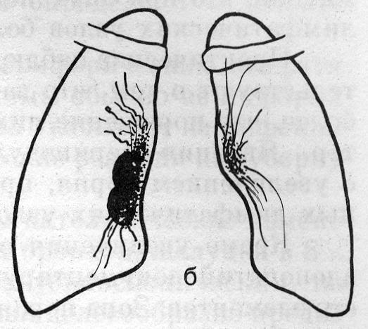 Опухолевидная форма туберкулеза внутригрудных лимфатических узлов (б)