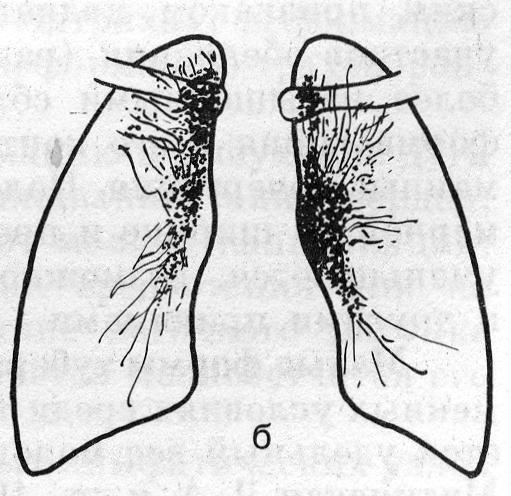 Инфильтративная форма туберкулеза внутригрудных лимфатических узлов (б)