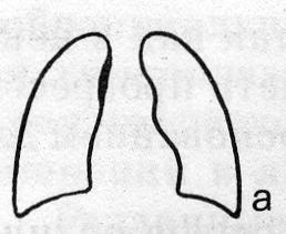 Схематическое изображение малых форм туберкулеза (а)