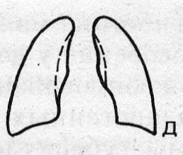 Схематическое изображение малых форм туберкулеза (д)