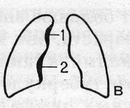 Схематическое изображение малых форм туберкулеза (в)