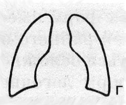Схематическое изображение малых форм туберкулеза (г)