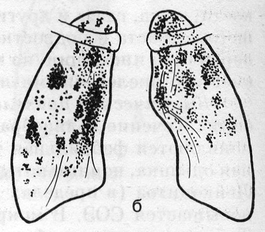 Подострый диссеминированный туберкулез (б)