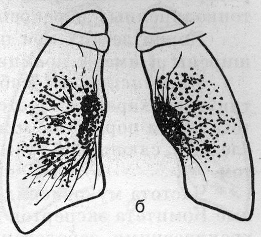 Легочная форма саркоидоза (б)