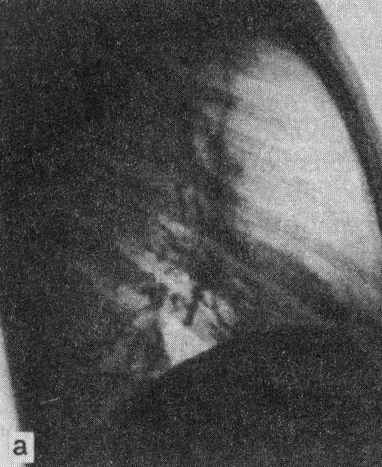 Цирроз средней доли, симулирующий междолевой плеврит (а)
