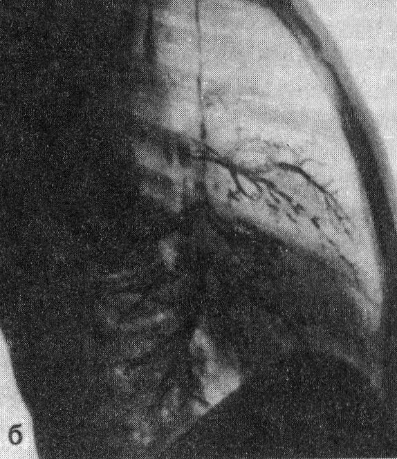 Цирроз средней доли, симулирующий междолевой плеврит (б)
