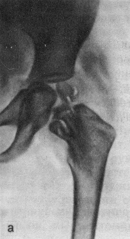 Рентгенограммы тазобедренного сустава (а)