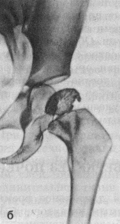 Рентгенограммы тазобедренного сустава (б)