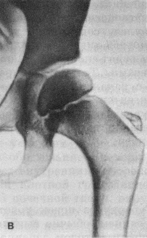 Рентгенограммы тазобедренного сустава (в)