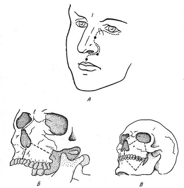 Схема операций при резекции верхней челюсти