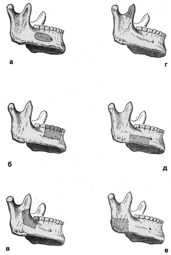 Частичная резекция нижней челюсти без нарушения ее непрерывности