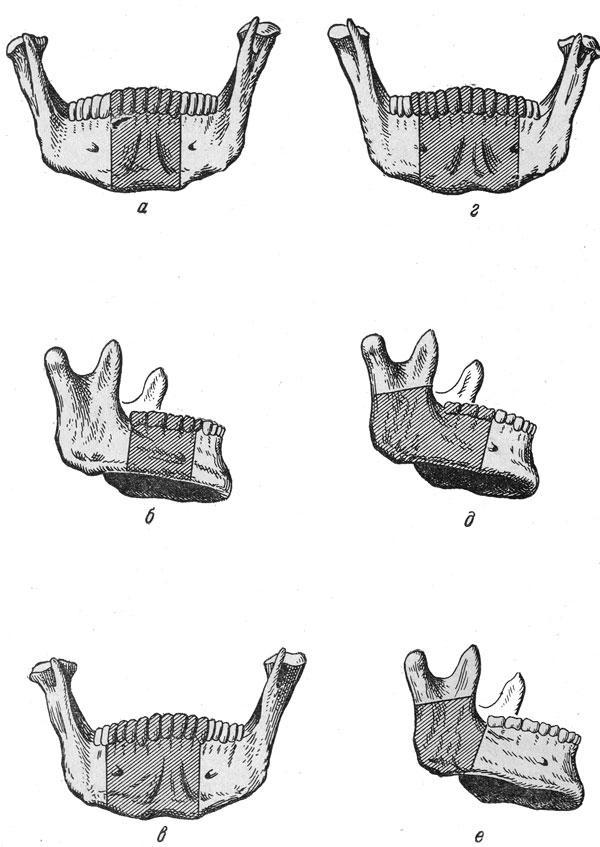 Частичная резекция нижней челюсти с нарушением ее непрерывности