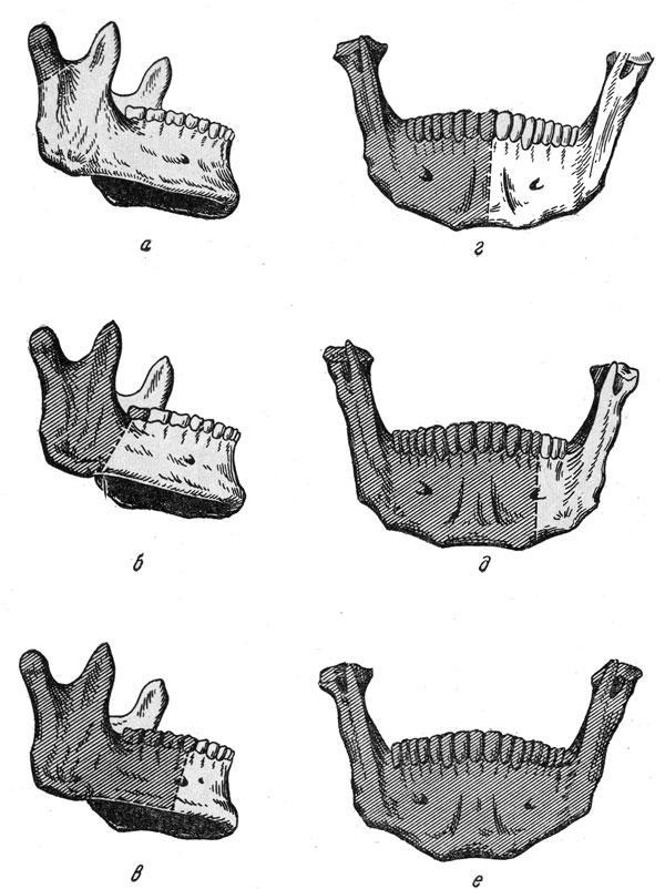 Полная резекция нижней челюсти с вычленением в височно-челюстном сустав
