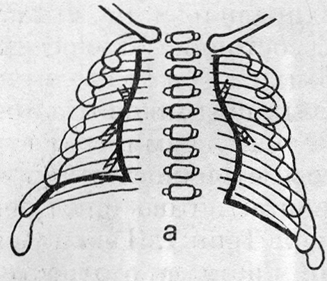 Схемы рентгенограмм органов грудной полости (а)